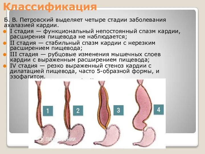 Классификация Б. В. Петров­ский выделяет четыре ста­дии заболевания ахалазией кардии. I