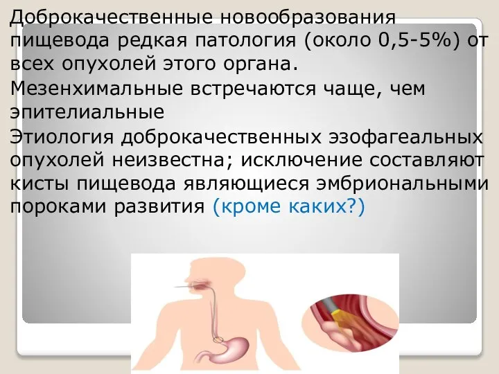 Доброкачественные новообразования пищевода редкая патология (около 0,5-5%) от всех опухолей этого