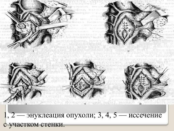 1, 2 — энуклеация опухоли; 3, 4, 5 — иссечение с участком стенки.