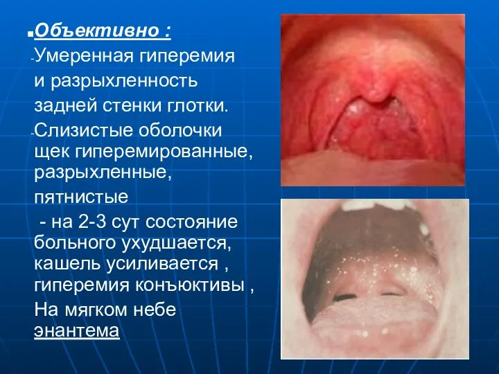 Объективно : Умеренная гиперемия и разрыхленность задней стенки глотки. Слизистые оболочки