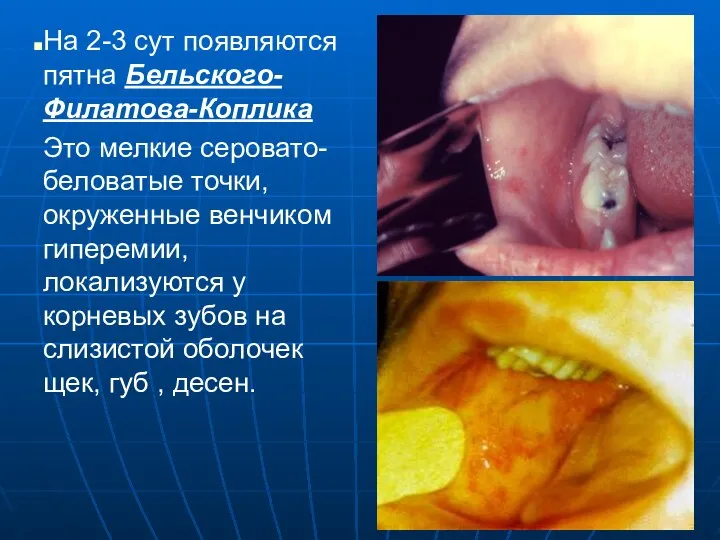 На 2-3 сут появляются пятна Бельского-Филатова-Коплика Это мелкие серовато-беловатые точки, окруженные