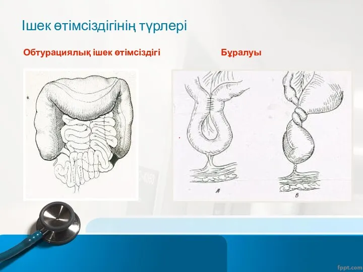 Ішек өтімсіздігінің түрлері Обтурациялық ішек өтімсіздігі . Бұралуы