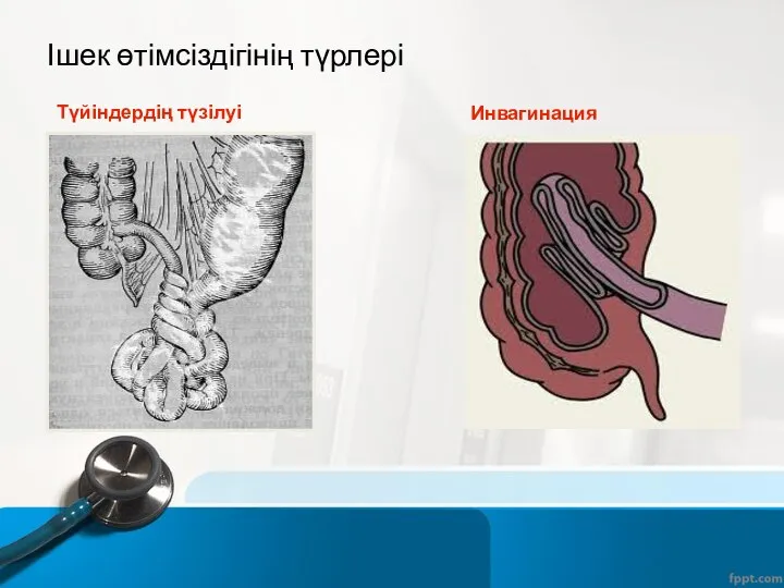 Түйіндердің түзілуі Инвагинация Ішек өтімсіздігінің түрлері