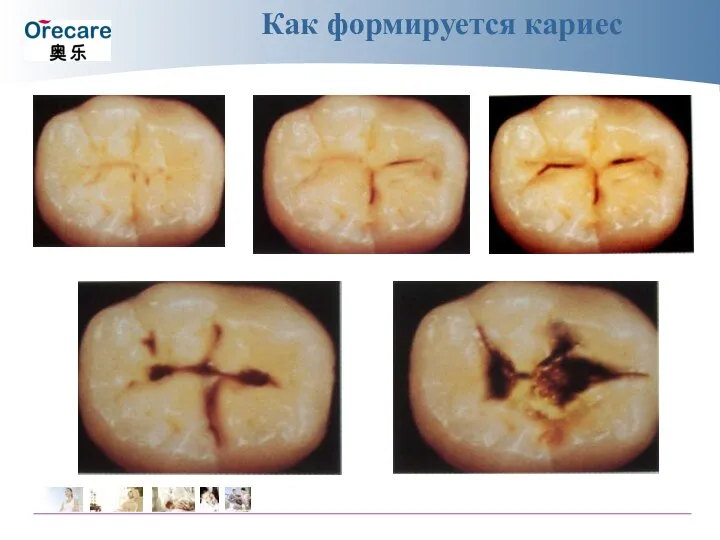 Как формируется кариес