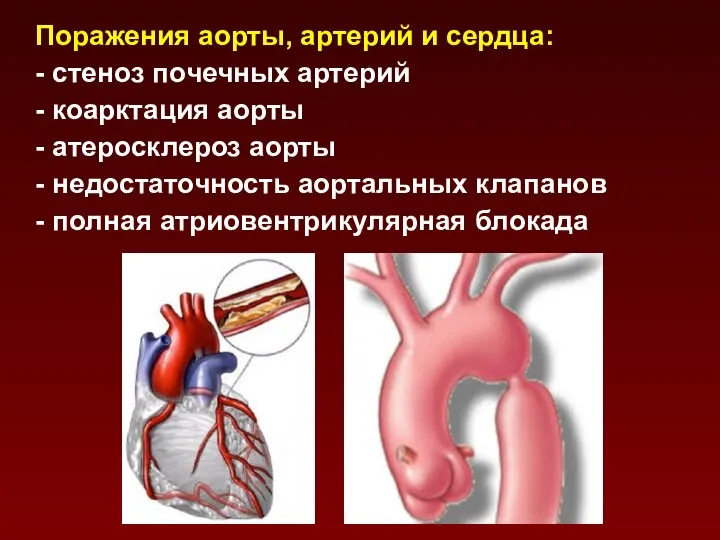 Поражения аорты, артерий и сердца: - стеноз почечных артерий - коарктация