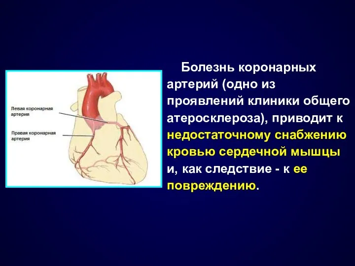 Болезнь коронарных артерий (одно из проявлений клиники общего атеросклероза), приводит к