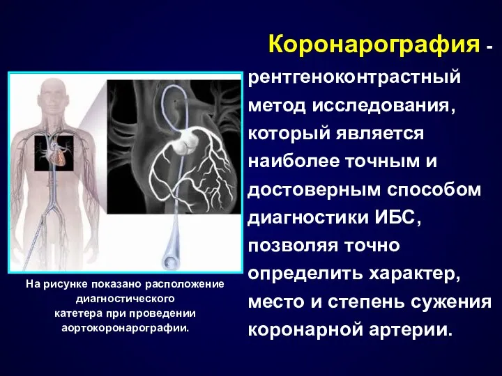 Коронарография - рентгеноконтрастный метод исследования, который является наиболее точным и достоверным