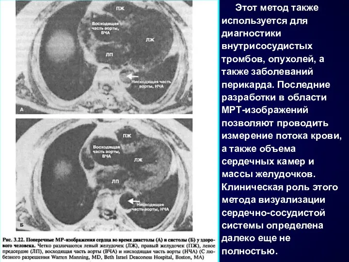 Этот метод также используется для диагностики внутрисосудистых тромбов, опухолей, а также