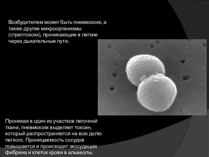 Возбудителем может быть пневмококк, а также другие микроорганизмы (стрептококк), проникающие в