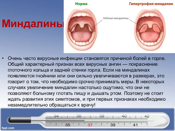 Миндалины Очень часто вирусные инфекции становятся причиной болей в горле. Общий