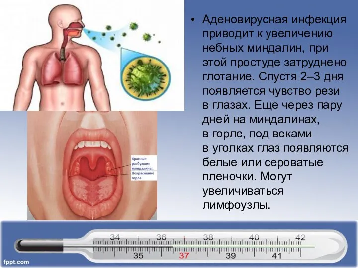 Аденовирусная инфекция приводит к увеличению небных миндалин, при этой простуде затруднено