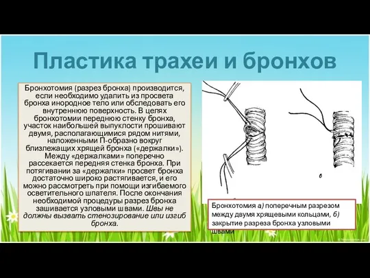 Пластика трахеи и бронхов Бронхотомия (разрез бронха) производится, если необходимо удалить