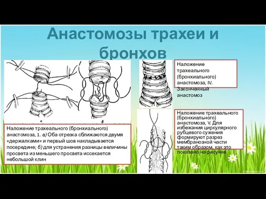 Анастомозы трахеи и бронхов Наложение трахеального (бронхиального) анастомоза, 1. а) Оба