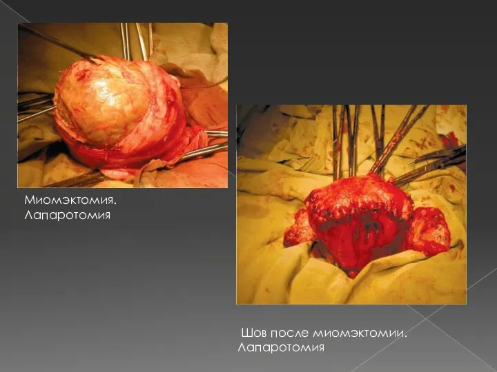 Миомэктомия. Лапаротомия Шов после миомэктомии. Лапаротомия