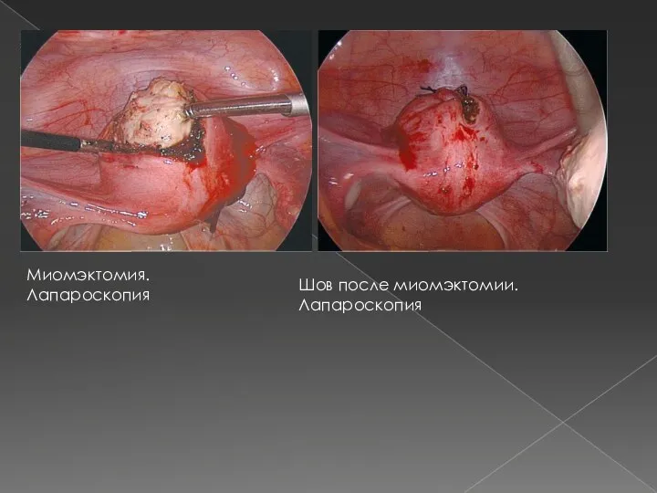 Миомэктомия. Лапароскопия Шов после миомэктомии. Лапароскопия