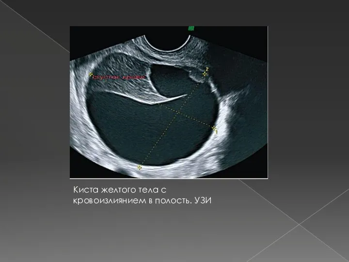 Киста желтого тела с кровоизлиянием в полость. УЗИ