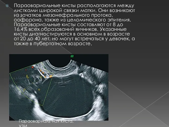 Параовариальные кисты располагаются между листками широкой связки матки. Они возникают из