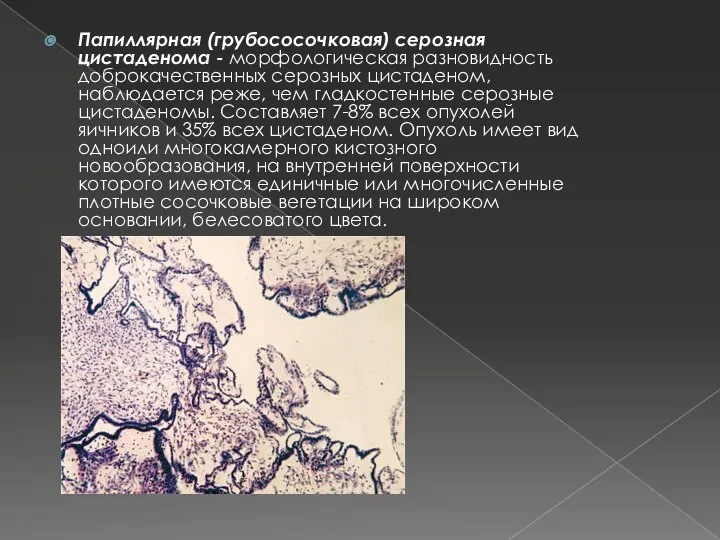 Папиллярная (грубососочковая) серозная цистаденома - морфологическая разновидность доброкачественных серозных цистаденом, наблюдается