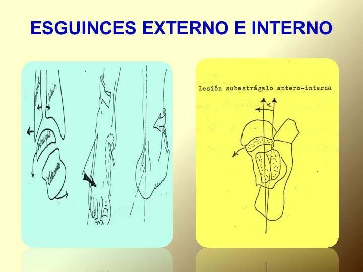 ESGUINCES EXTERNO E INTERNO