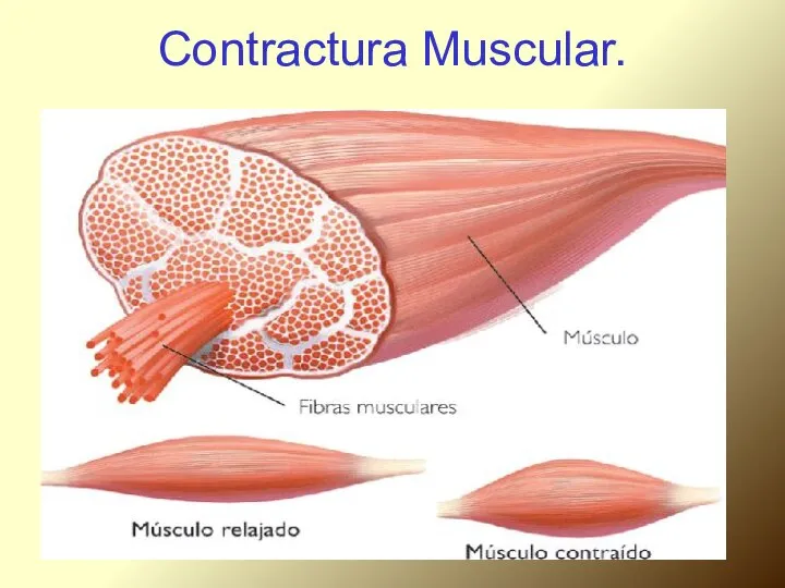 Contractura Muscular.