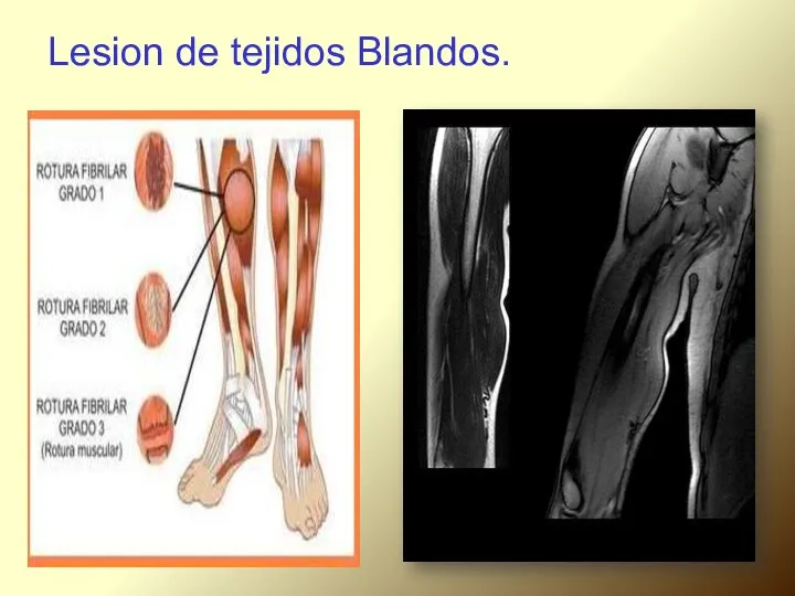 Lesion de tejidos Blandos.