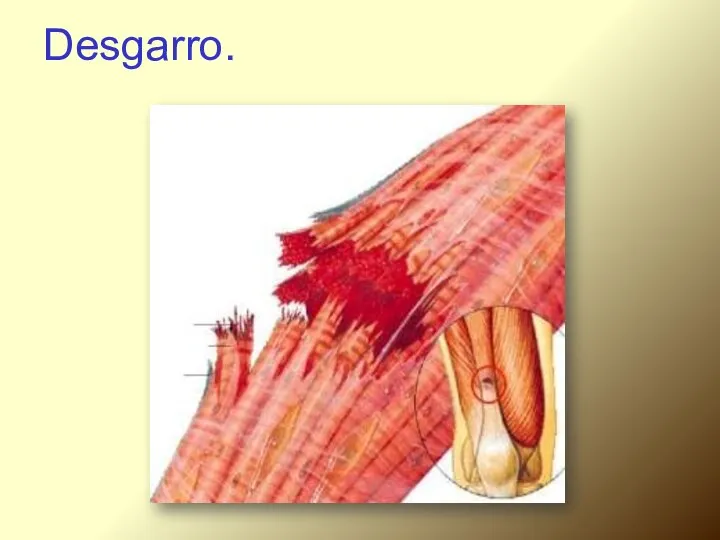 Desgarro.