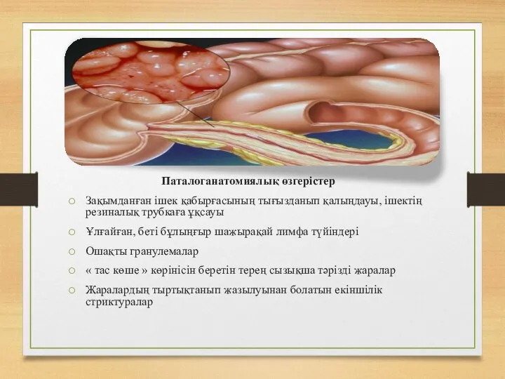 Паталоганатомиялық өзгерістер Зақымданған ішек қабырғасының тығызданып қалыңдауы, ішектің резиналық трубкаға ұқсауы