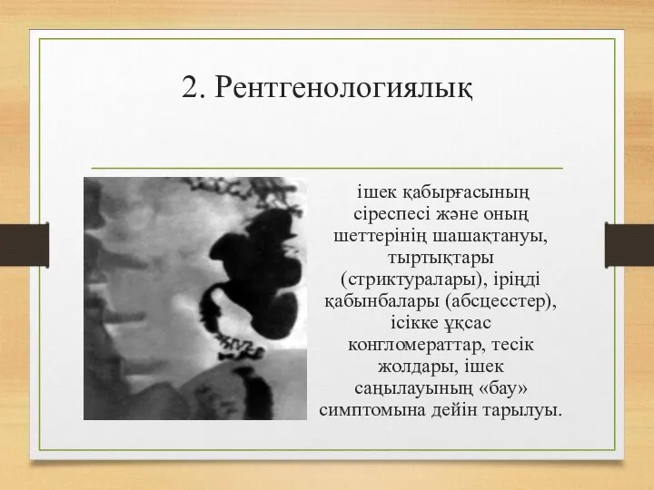 2. Рентгенологиялық ішек қабырғасының сіреспесі жəне оның шеттерінің шашақтануы, тыртықтары (стриктуралары),