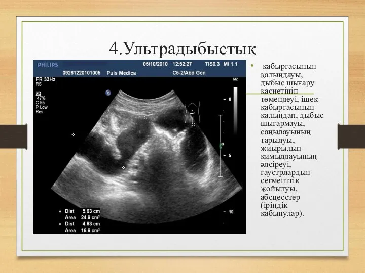 4.Ультрадыбыстық қабырғасының қалыңдауы, дыбыс шығару қасиетінің төмендеуі, ішек қабырғасының қалыңдап, дыбыс