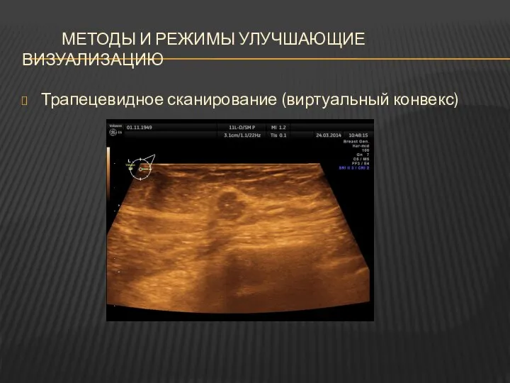 МЕТОДЫ И РЕЖИМЫ УЛУЧШАЮЩИЕ ВИЗУАЛИЗАЦИЮ Трапецевидное сканирование (виртуальный конвекс)