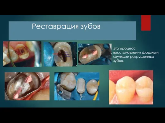 Реставрация зубов это процесс восстановления формы и функции разрушенных зубов.