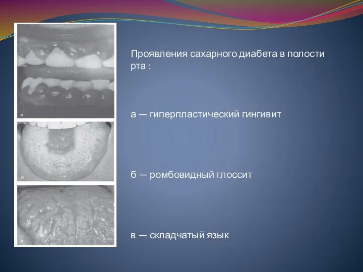 Проявления сахарного диабета в полости рта : а — гиперпластический гингивит