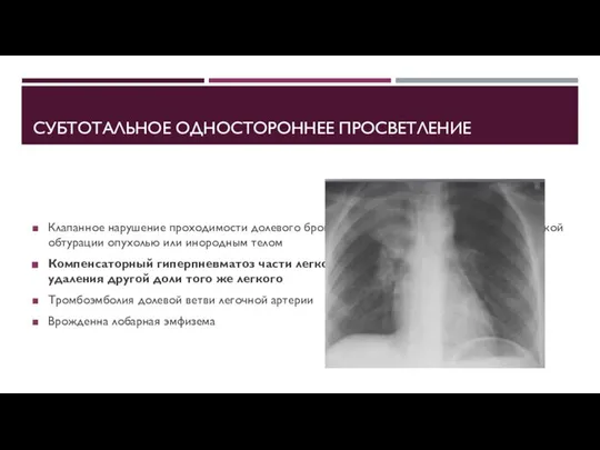 СУБТОТАЛЬНОЕ ОДНОСТОРОННЕЕ ПРОСВЕТЛЕНИЕ Клапанное нарушение проходимости долевого бронха, вследствие его частичной