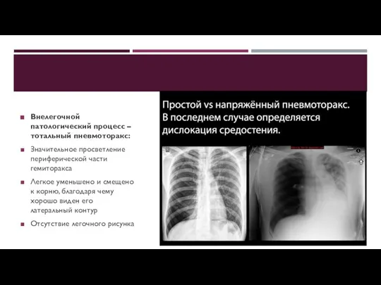 Внелегочной патологический процесс – тотальный пневмоторакс: Значительное просветление периферической части гемиторакса