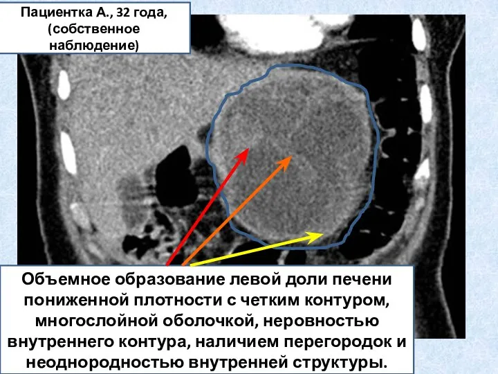 Объемное образование левой доли печени пониженной плотности с четким контуром, многослойной