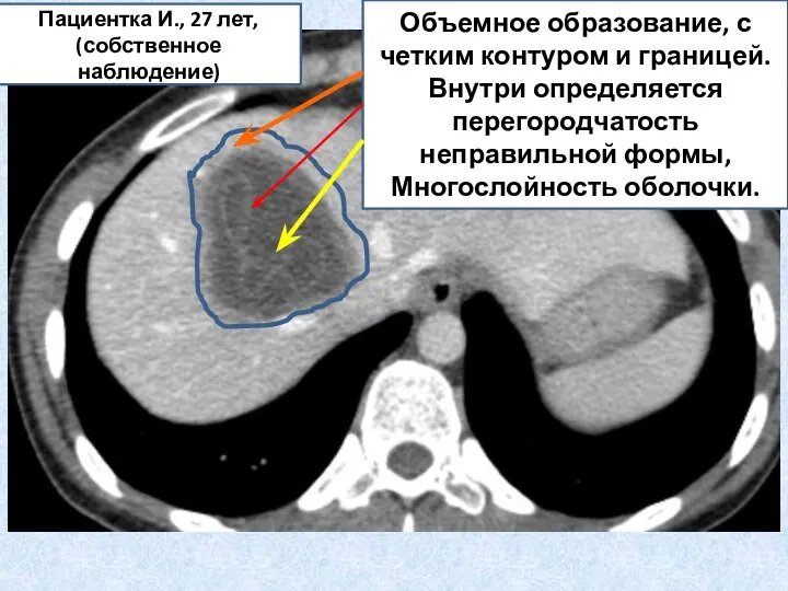 Объемное образование, с четким контуром и границей. Внутри определяется перегородчатость неправильной