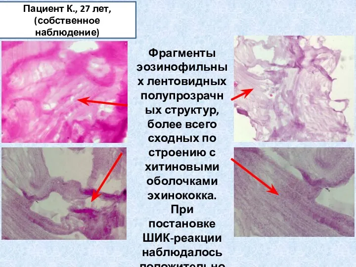 Пациент К., 27 лет, (собственное наблюдение) Фрагменты эозинофильных лентовидных полупрозрачных структур,