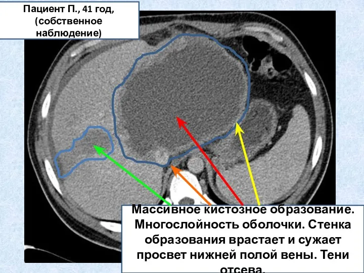 Массивное кистозное образование. Многослойность оболочки. Стенка образования врастает и сужает просвет