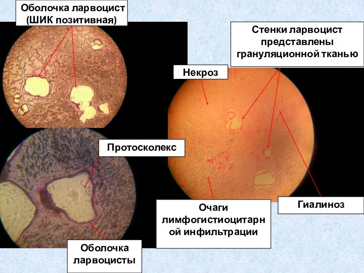 Стенки ларвоцист представлены грануляционной тканью Гиалиноз Некроз Очаги лимфогистиоцитарной инфильтрации Протосколекс