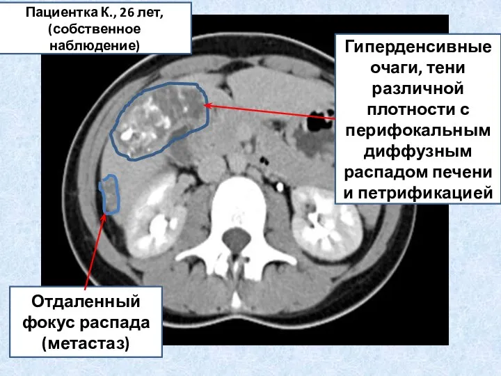 Гиперденсивные очаги, тени различной плотности с перифокальным диффузным распадом печени и