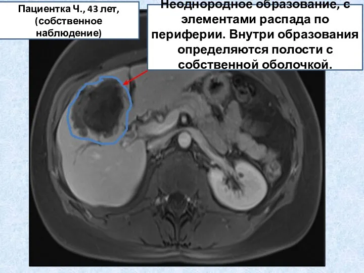 Неоднородное образование, с элементами распада по периферии. Внутри образования определяются полости