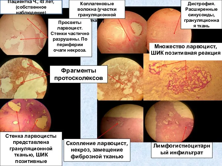 Просветы ларвоцист. Стенки частично разрушены. По периферии очаги некроза. Коллагеновые волокна