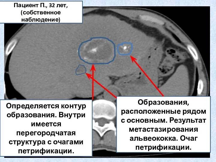 Определяется контур образования. Внутри имеется перегородчатая структура с очагами петрификации. Образования,