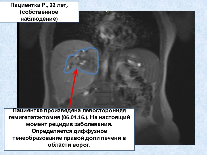 Пациентке произведена левосторонняя гемигепатэктомия (06.04.16.). На настоящий момент рецидив заболевания. Определяется