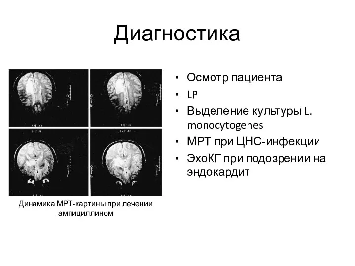 Диагностика Осмотр пациента LP Выделение культуры L. monocytogenes МРТ при ЦНС-инфекции