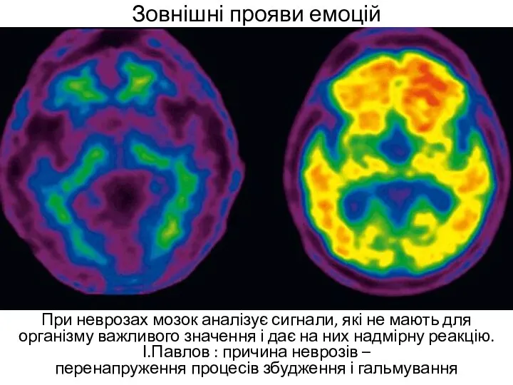 Зовнішні прояви емоцій При неврозах мозок аналізує сигнали, які не мають