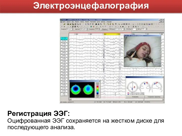 Регистрация ЭЭГ: Оцифрованная ЭЭГ сохраняется на жестком диске для последующего анализа. Электроэнцефалография