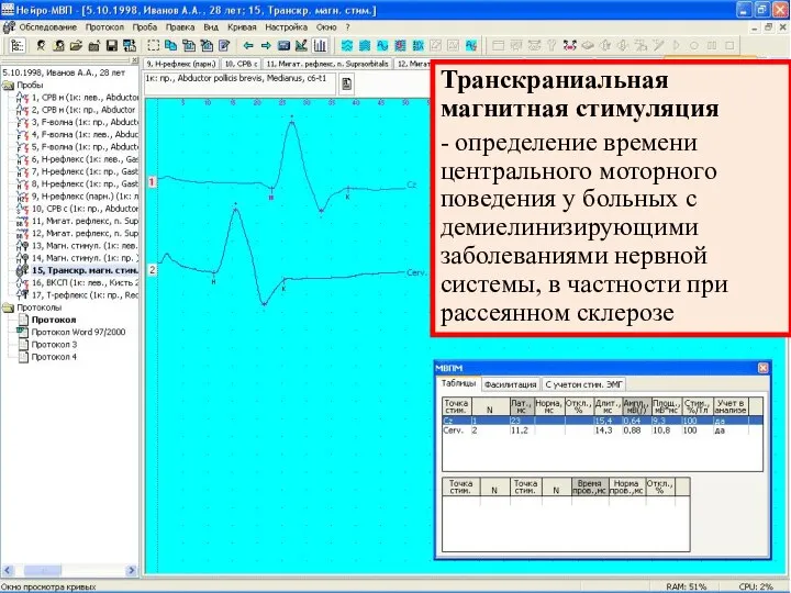 Транскраниальная магнитная стимуляция - определение времени центрального моторного поведения у больных