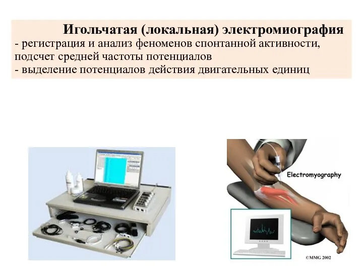 Игольчатая (локальная) электромиография - регистрация и анализ феноменов спонтанной активности, подсчет