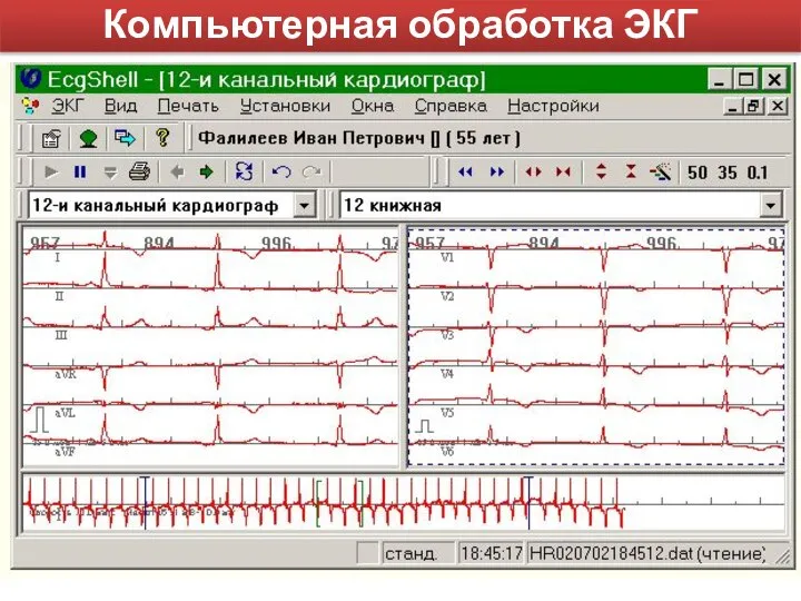 Компьютерная обработка ЭКГ